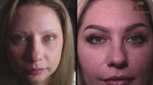 Все про пересадку бровей.