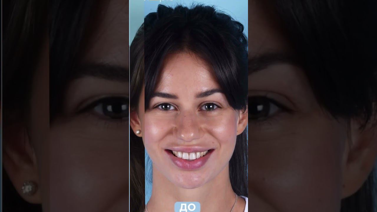 Улыбка для нашей прекрасной пациентки  #виниры #стоматология #элайнеры