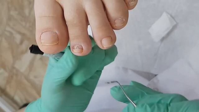 Размер не имеет значения. Скоба Фрезера смотреть онлайн
