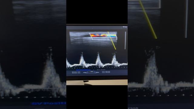 Идеальный кровоток в сонной артерии. Узи сосудов. Флеболог Москва. Флеболог смотреть онлайн