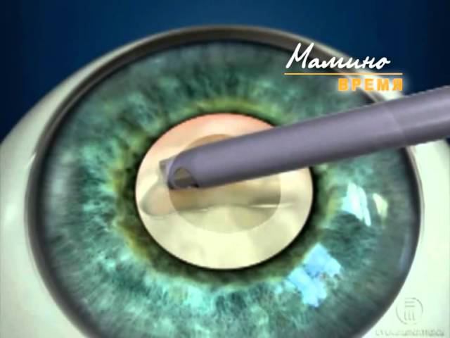 Катаракта. Лечение катаракты. Операция по удалению катаракты. смотреть онлайн