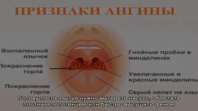Можно ли купаться во время ангины смотреть онлайн