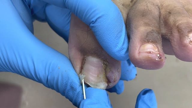 5 Super Long Ingrown Toenails! The Patient Is Very Uncomfortable 【Podiatrist Lin Jun】