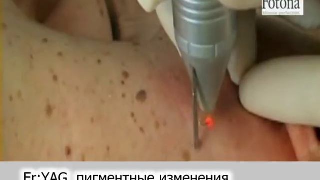 Лазерное FT удаление пигментации в медицинском центре Женское Здоровье в городе Ноябрьск смотреть онлайн