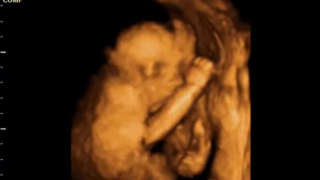 Моё 3D Узи часть 6 смотреть онлайн