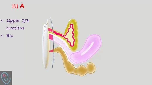 FIGO Staging Of Vulvar Cancer 2021