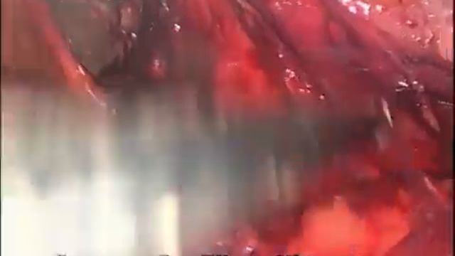 Лапароскопическая герниопластика однопортовая  ТАПП ручное наложение швов SILS HERNIA REPAIR TAPP