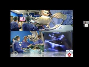 Онлайн-лекция «Опухоли головного мозга симптомы, диагностика и лечение»