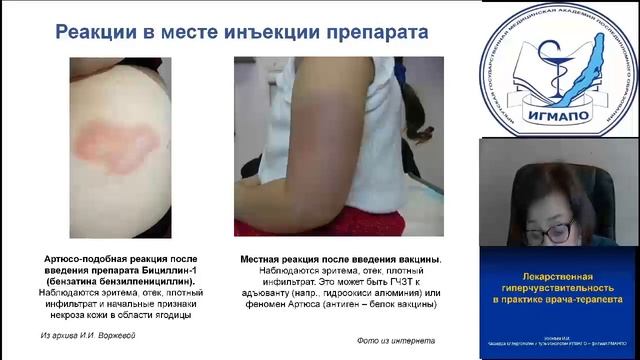Лекарственная гиперчувствительность в практике врача терапевта Воржева ИИ.mp4