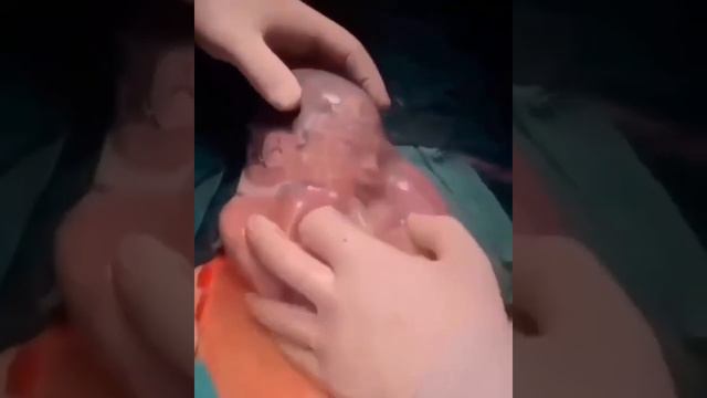 rare baby born without amniotic fluids смотреть онлайн