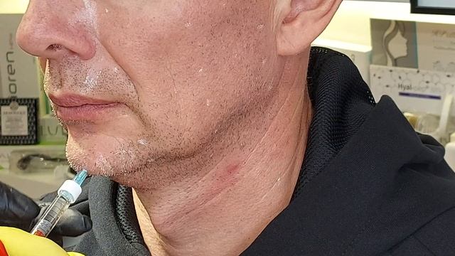 ГК 2 Ml. Подбородок(работа с подбородочным выступом и губо-подб.складками). Фрагмент.