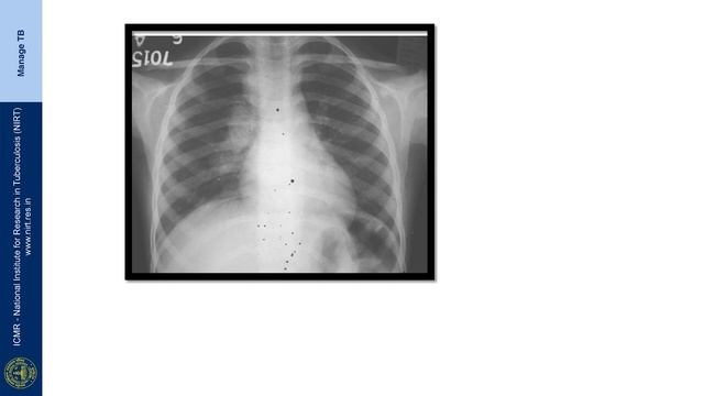 30 Diagnosis of Childhood Tuberculosis Session 01 смотреть онлайн