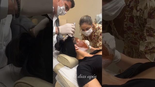 PEELING DE FENOL! Resultado emocionante смотреть онлайн