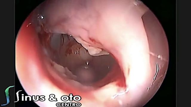 Sinuplastia em paciente em UTI смотреть онлайн