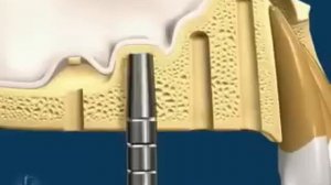 закрытый синуслифтинг остеотомами