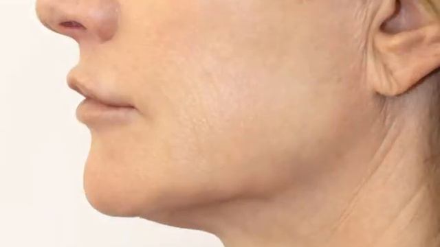 Dr De Silva Jawline Filler Progression смотреть онлайн