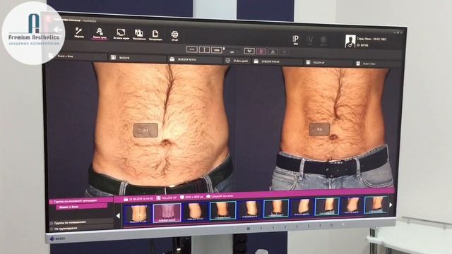 ПРОЦЕДУРА НА АППАРАТЕ COOLSCULPTING - ИДЕАЛЬНОЕ ТЕЛО БЕЗ УСИЛИЙ И БОЛИ. 05.09.2019. смотреть онлайн