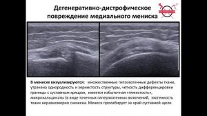#УЗИ менисков коленного сустава