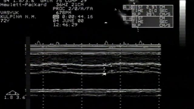 Аортальный стеноз. Эхокардиография © Aortic Stenosis. Echocardiographic Diagnosis