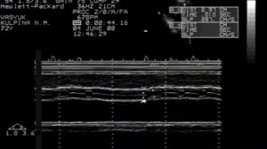 Аортальный стеноз. Эхокардиография © Aortic stenosis. Echocardiographic diagnosis