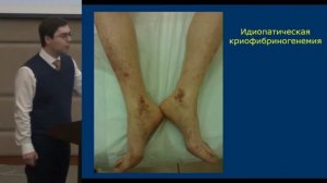 Смитиенко И.О. Васкулиты кожи и их имитаторы | Кожный васкулит | Капилярит кожи