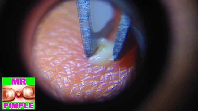 The Pimple Through The Lens - Mr. Pimple