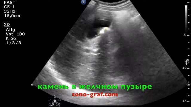 147 - УЗИ - Камень в желчном пузыре смотреть онлайн