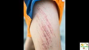 Виды кровотечений: артериальное, венозное, капиллярное/ Анатомия человека