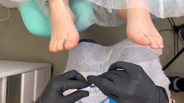 Тейпирование от вросших ногтей