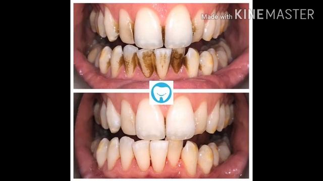 দাঁত স্কেলিং এর খরচ || দাঁত স্কেলিং কিভাবে করে || Dental Care BD смотреть онлайн