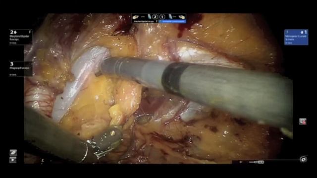 Extended Template Pelvic Lymph Node dissection--"Spaces" смотреть онлайн