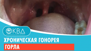 ? Хроническая гонорея горла. Клинический случай №811