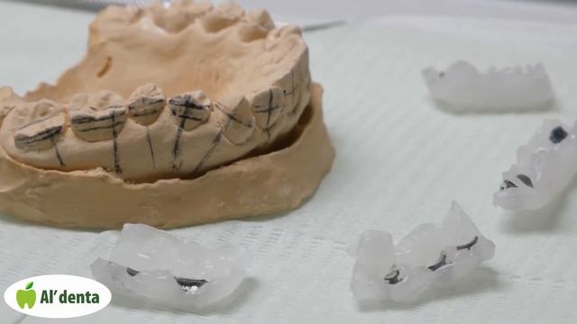 Клиника Альдента, Иркутск. Этап установки брекетов смотреть онлайн