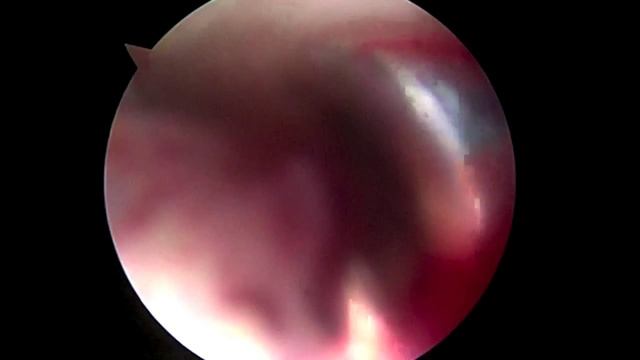 CA L Biceps Tenodesis 8 3 15