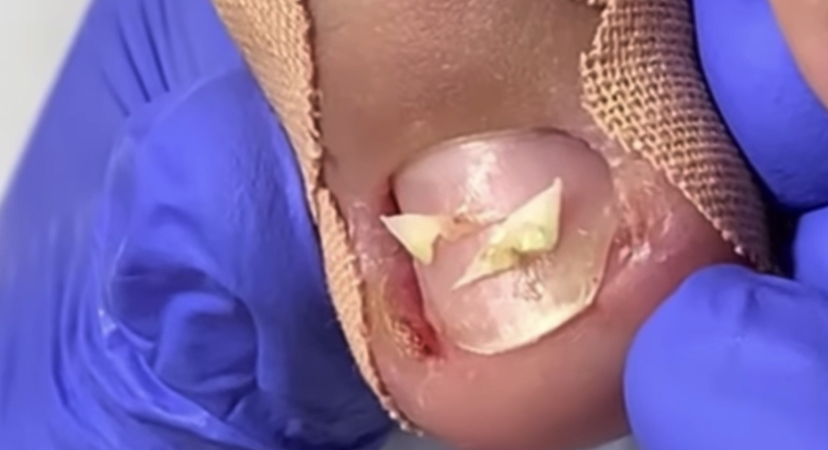 Вросший ноготь??⚠️❗️??