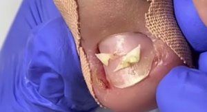 Вросший ноготь??⚠️❗️??