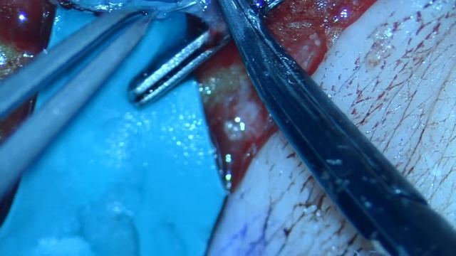 LVA ( Lymphatico-venous anastomosis) for lymphedema treatment смотреть онлайн