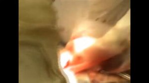 Оперативное лечение грыж передней брюшной стенки способом sub lay