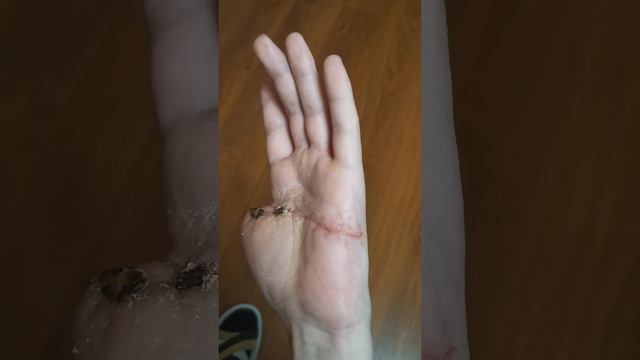 травма кисти и разрыв сгибателя пальца смотреть онлайн