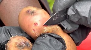 Ezekiel jigger digging - dropped out of school cuz of jiggers watch full video @riseupsociety.net