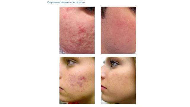 Fotona Новые возможности лазерного омоложения смотреть онлайн