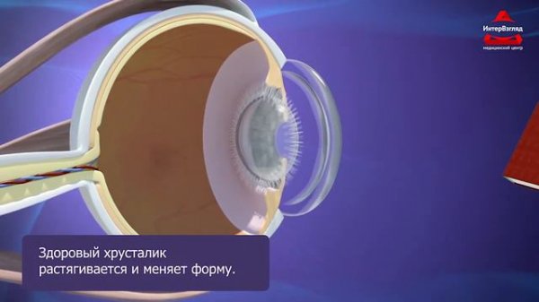 Что такое пресбиопия