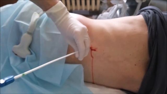 Нефростомия