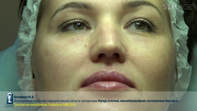 Отрывок мастер-класса "Инъекционная коррекция периорбитальной области препаратами Stylage", СЭМ-201 смотреть онлайн