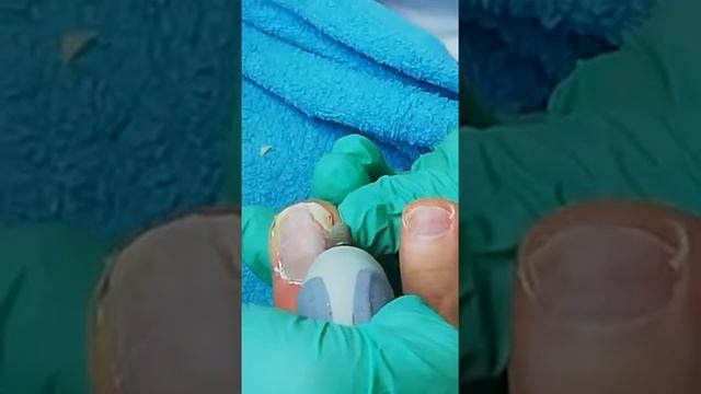 Зачистка онихолизиса (отслойки ногтя от ногтевого ложа)