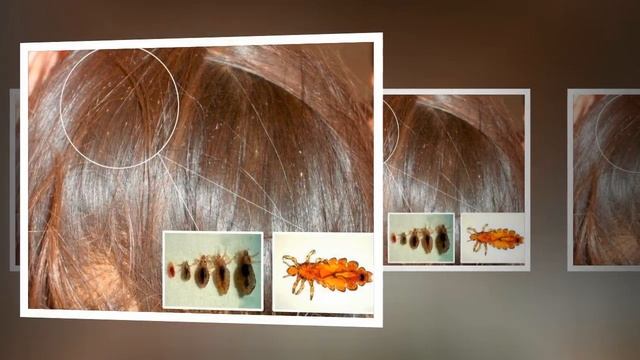 ★ Как избавиться от вшей и гнид в голове. Лечение педикулеза. Эффективные препараты от вшей. смотреть онлайн