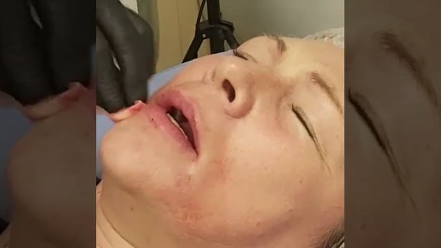 АирисКом студенты учатся: лёгкая коррекция возрастных губ после 50 лет филлером. смотреть онлайн