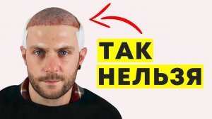 Кому нельзя пересаживать волосы. Самое важное про пересадку волос | Александр Долгов