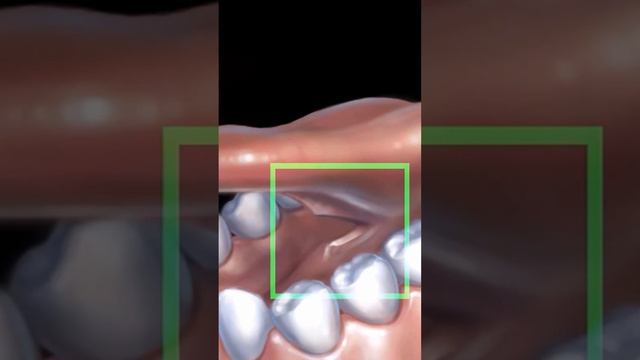 Пластика уздечки языка #vatech #reels смотреть онлайн