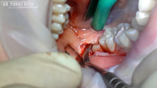 Удаление полуретенированных зубов мудрости. Wisdom teeth extraction смотреть онлайн